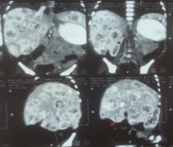 Infantile Liver Hemangiopericytoma